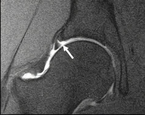 acetabular labral tear tests|best imaging for labral tear.